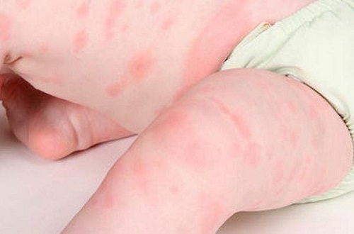 Các dấu hiệu nhận biết trẻ bị dị ứng khi mặc bỉm