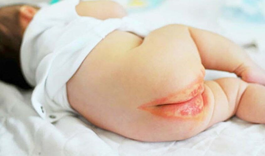 dị ứng tã ba mẹ cần đưa bé đi thăm khám