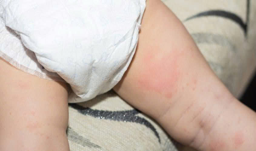 Bé cần được thay bỉm định kỳ để tránh hăm tã